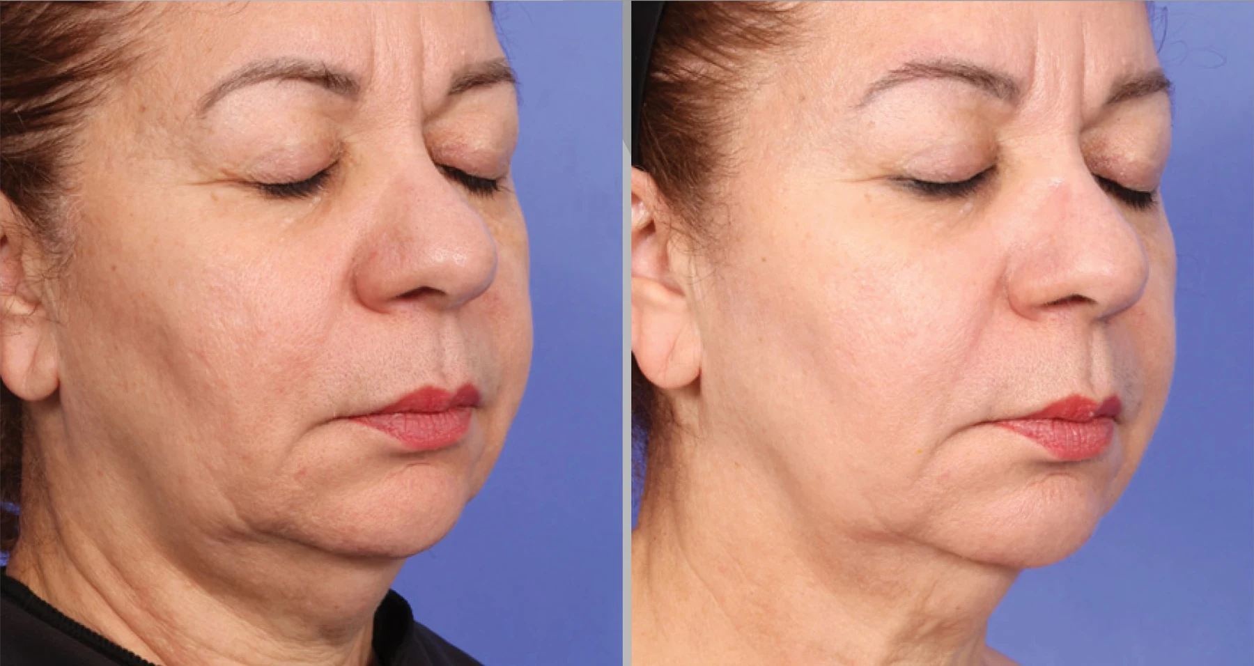 Clinical comparison example after one treatment; individual outcomes vary.