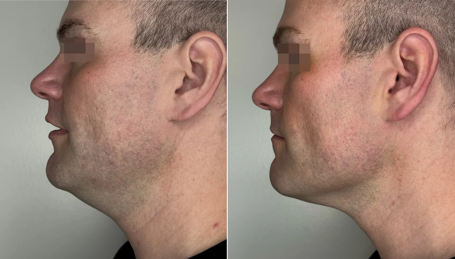 Clinical comparison example after two treatments; individual outcomes vary.