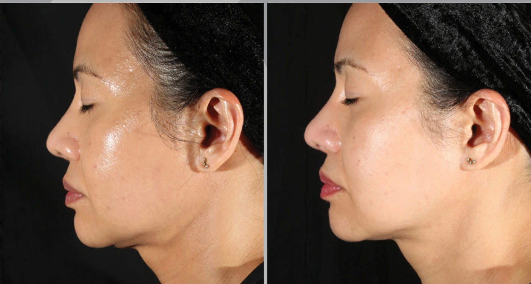Clinical comparison example after one treatment; individual outcomes vary.
