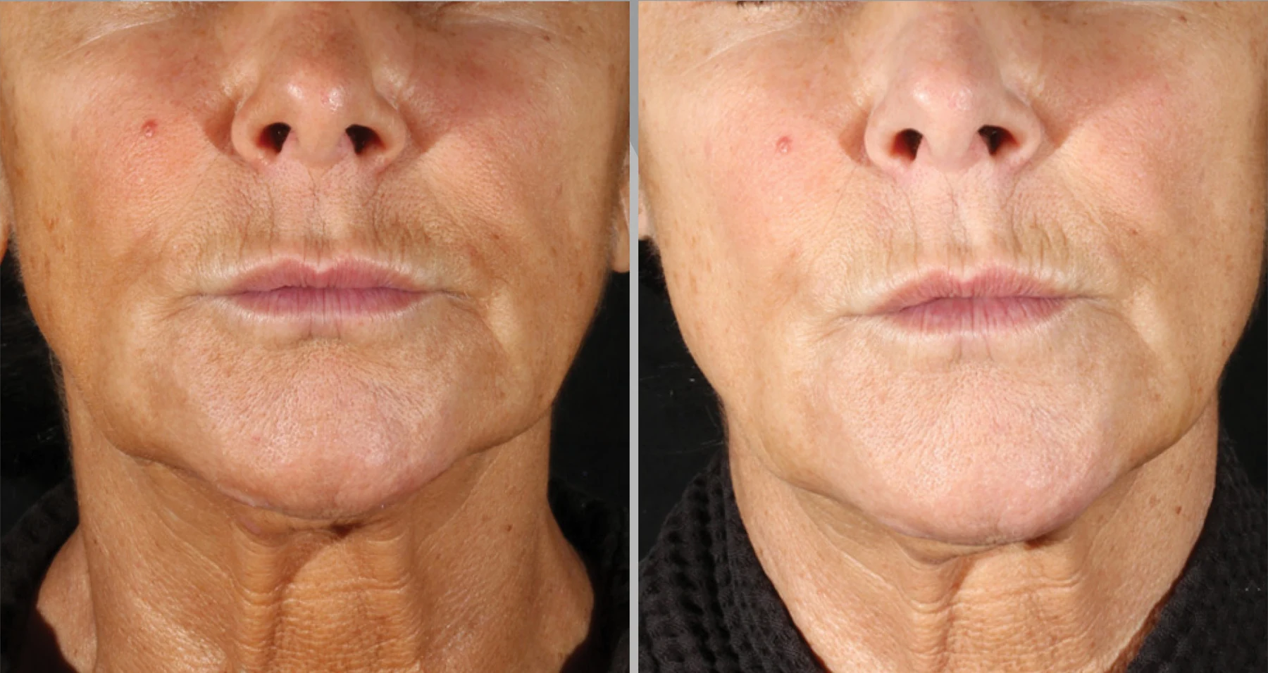 Clinical comparison example, front view after two treatments; individual outcomes vary.