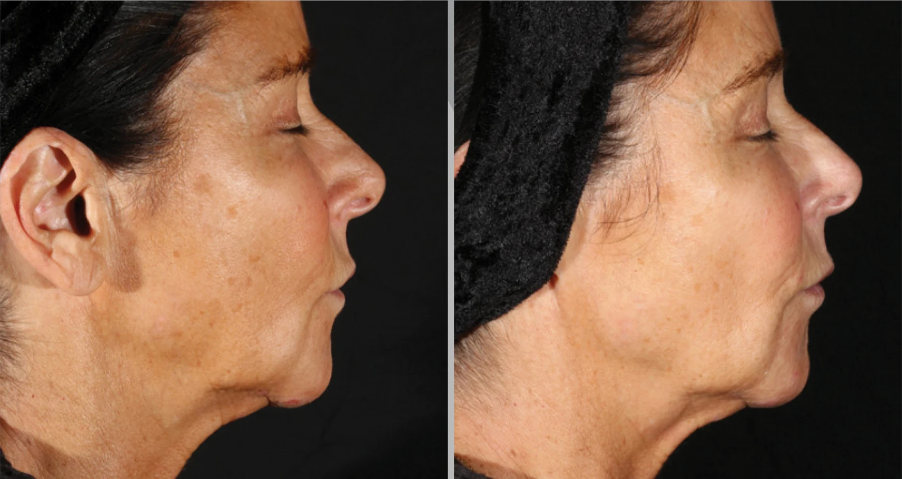 Clinical comparison example, profile after one treatment; individual outcomes vary.