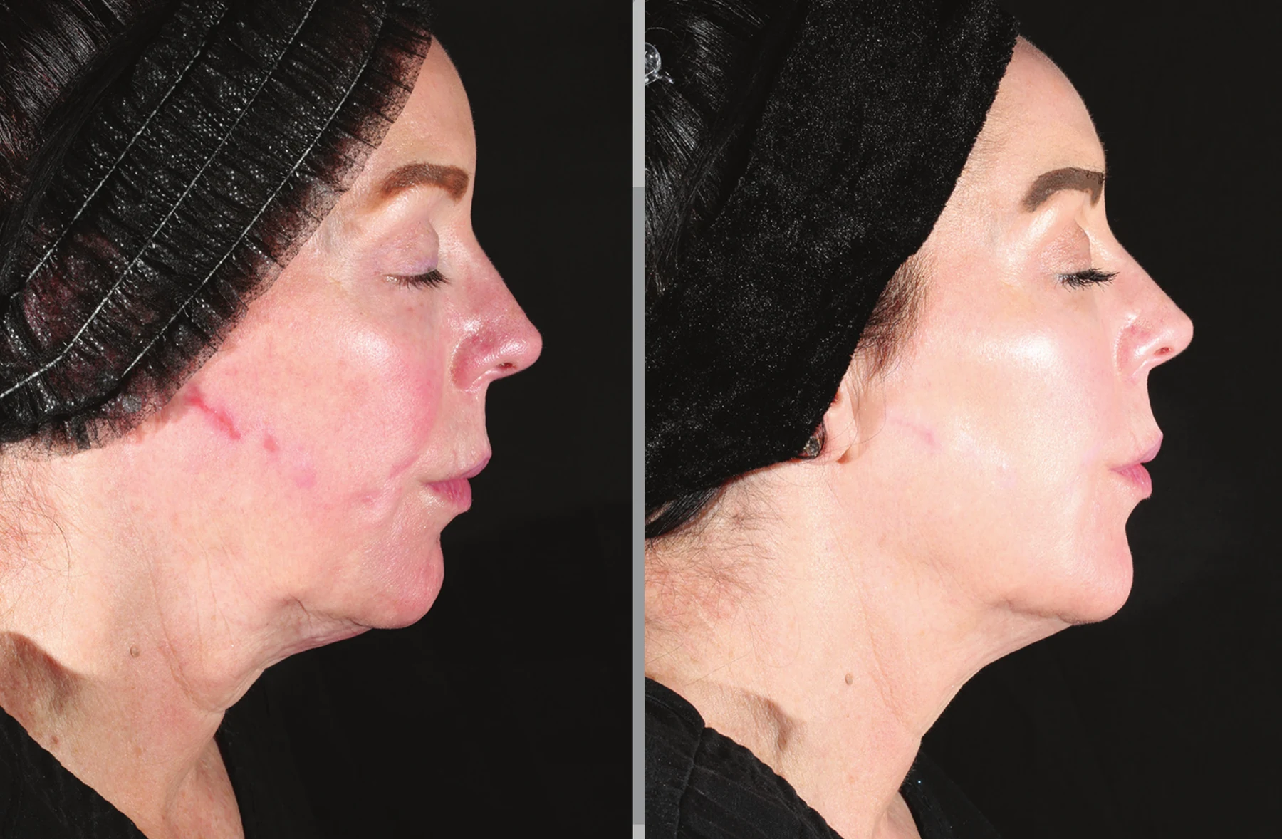 Clinical comparison example, profile after two treatments; individual outcomes vary.