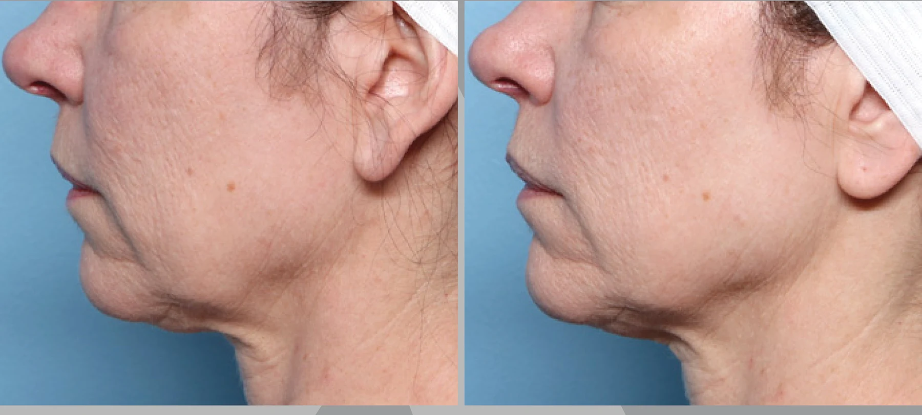 Clinical comparison example after two treatments; individual outcomes vary.